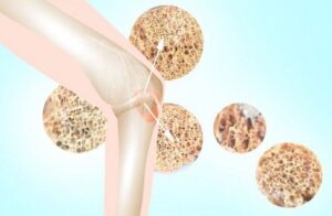 Loãng xương và những triệu chứng thường gặp