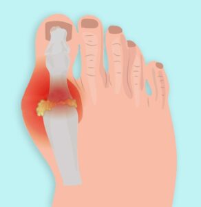 HÌnh ảnh cho thấy bệnh gout tàn phá như thế nào